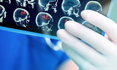 PET Brain Scanning Technology Used to Study the Neurology of Depression